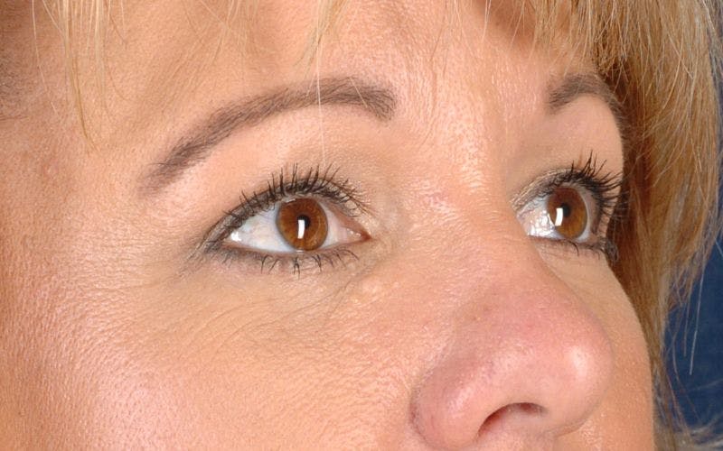 Blepharoplasty Before & After Gallery - Patient 9698213 - Image 6