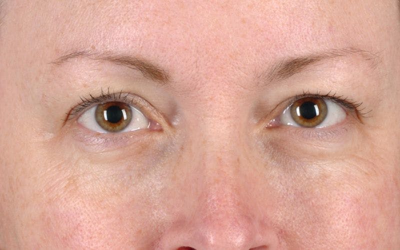 Blepharoplasty Before & After Gallery - Patient 9698215 - Image 1