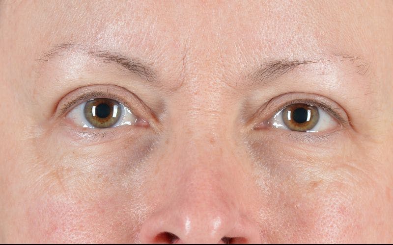 Blepharoplasty Before & After Gallery - Patient 9698215 - Image 2