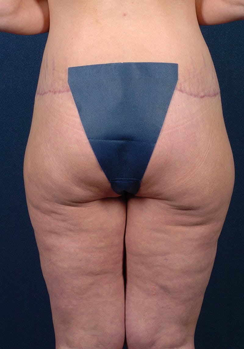 Lower Body Lift Before & After Gallery - Patient 9698214 - Image 8