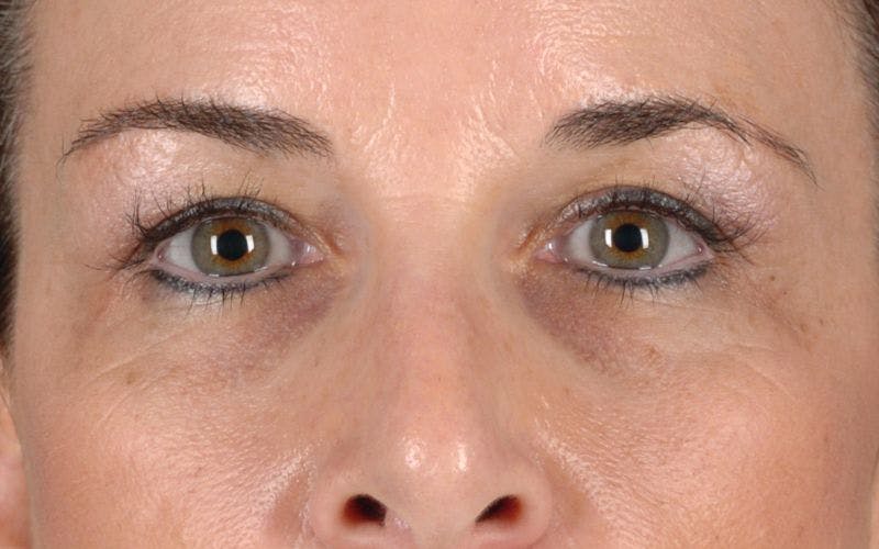 Blepharoplasty Before & After Gallery - Patient 9698221 - Image 1