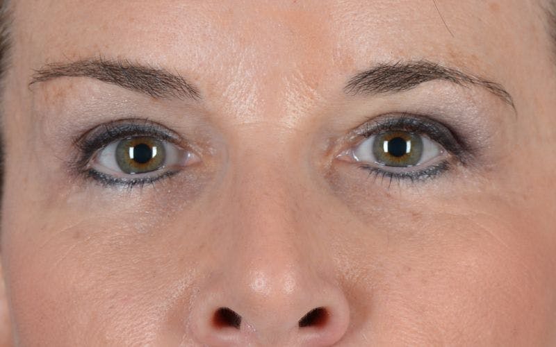Blepharoplasty Before & After Gallery - Patient 9698221 - Image 2