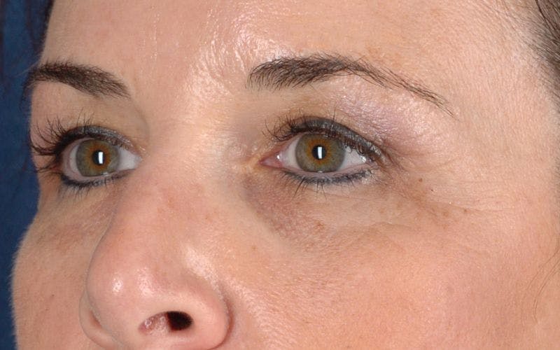 Blepharoplasty Before & After Gallery - Patient 9698221 - Image 3