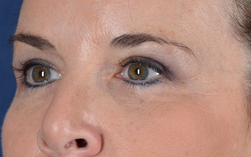 Blepharoplasty Before & After Gallery - Patient 9698221 - Image 4