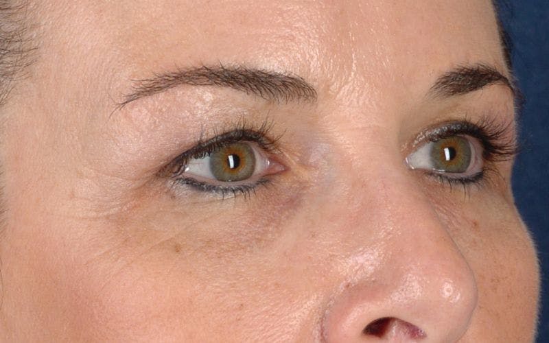 Blepharoplasty Before & After Gallery - Patient 9698221 - Image 5