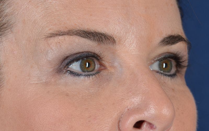 Blepharoplasty Before & After Gallery - Patient 9698221 - Image 6