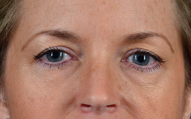 Blepharoplasty Before & After Gallery - Patient 9698223 - Image 1