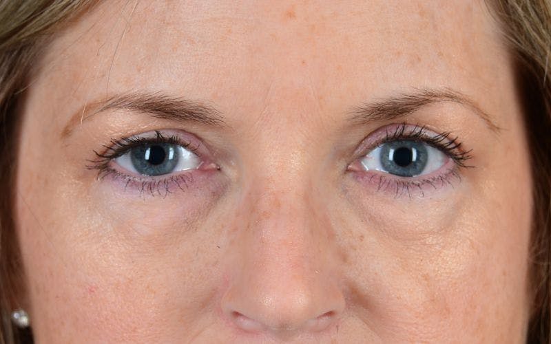 Blepharoplasty Before & After Gallery - Patient 9698223 - Image 2