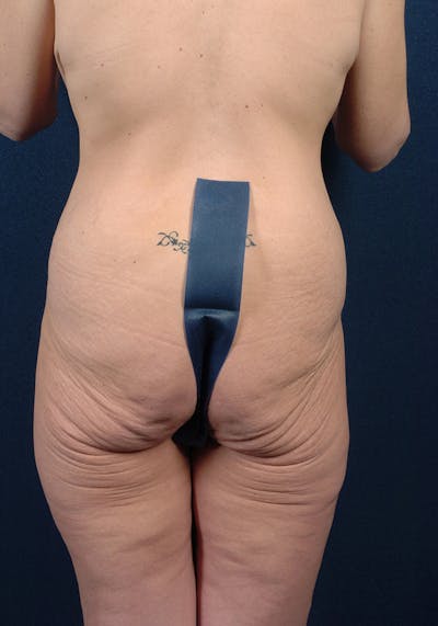 Lower Body Lift Before & After Gallery - Patient 9698222 - Image 7