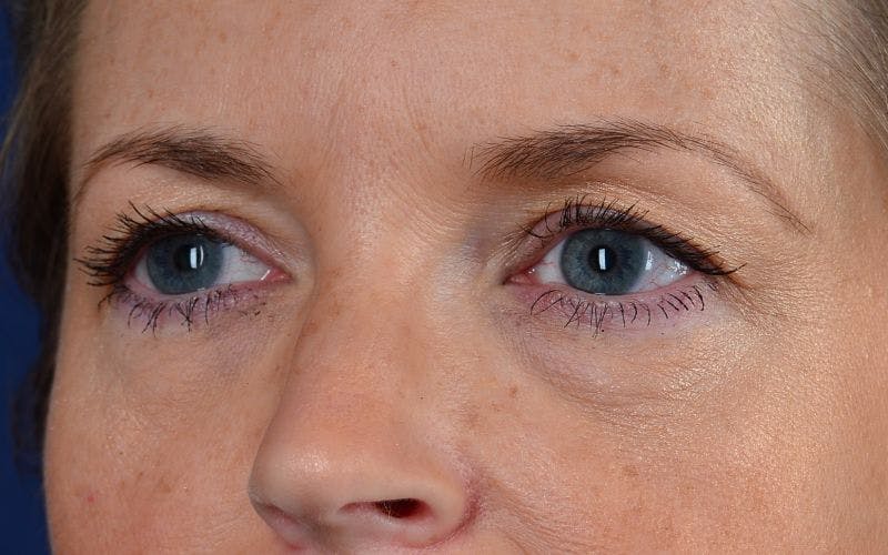 Blepharoplasty Before & After Gallery - Patient 9698223 - Image 3