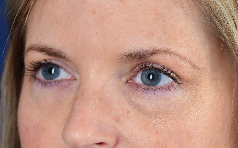 Blepharoplasty Before & After Gallery - Patient 9698223 - Image 4