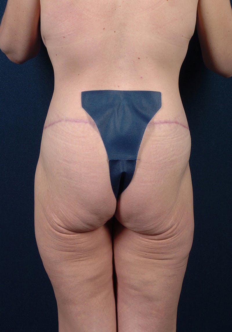 Lower Body Lift Before & After Gallery - Patient 9698222 - Image 8