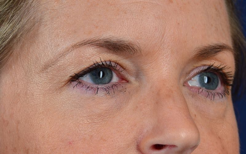 Blepharoplasty Before & After Gallery - Patient 9698223 - Image 5