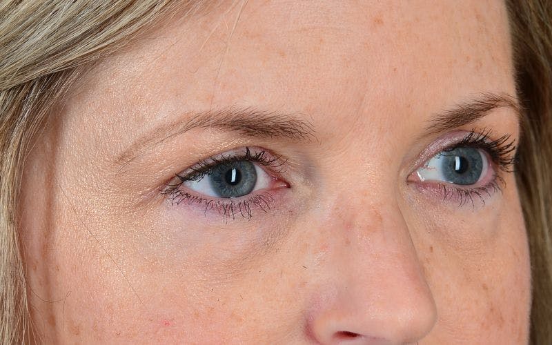 Blepharoplasty Before & After Gallery - Patient 9698223 - Image 6