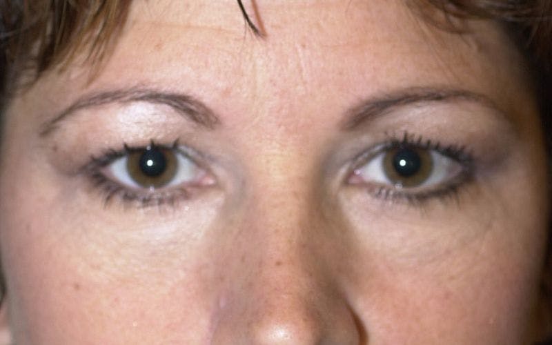 Blepharoplasty Before & After Gallery - Patient 9698226 - Image 1