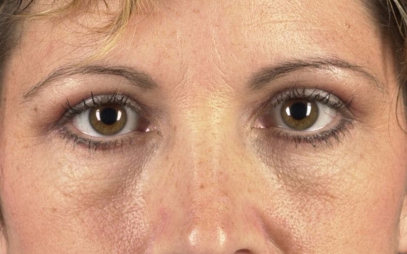 Blepharoplasty Before & After Gallery - Patient 9698226 - Image 2