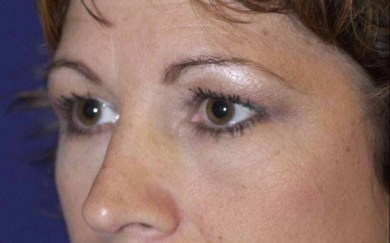 Blepharoplasty Before & After Gallery - Patient 9698226 - Image 3