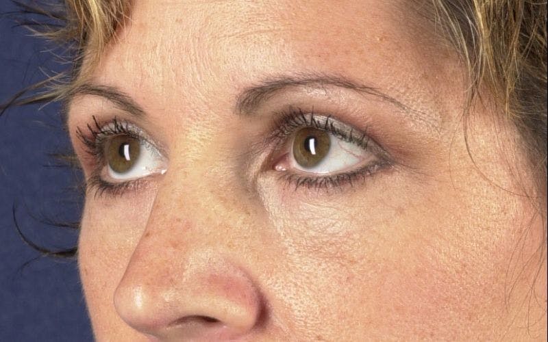 Blepharoplasty Before & After Gallery - Patient 9698226 - Image 4