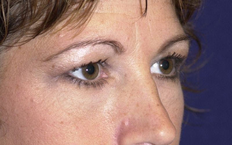 Blepharoplasty Before & After Gallery - Patient 9698226 - Image 5