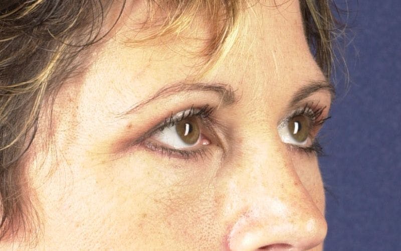 Blepharoplasty Before & After Gallery - Patient 9698226 - Image 6
