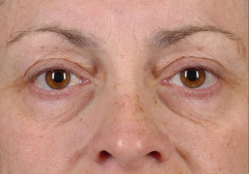 Blepharoplasty Before & After Gallery - Patient 9698228 - Image 1