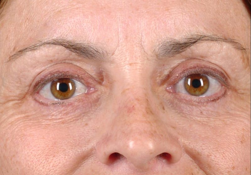 Blepharoplasty Before & After Gallery - Patient 9698228 - Image 2