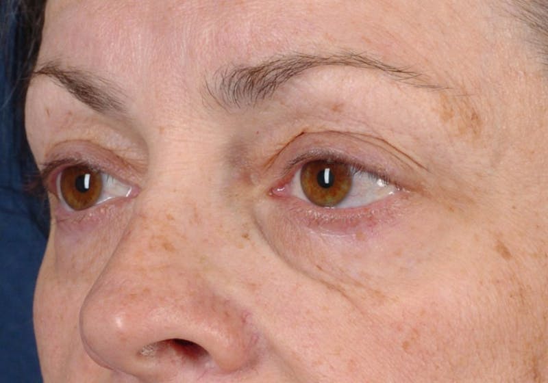 Blepharoplasty Before & After Gallery - Patient 9698228 - Image 3