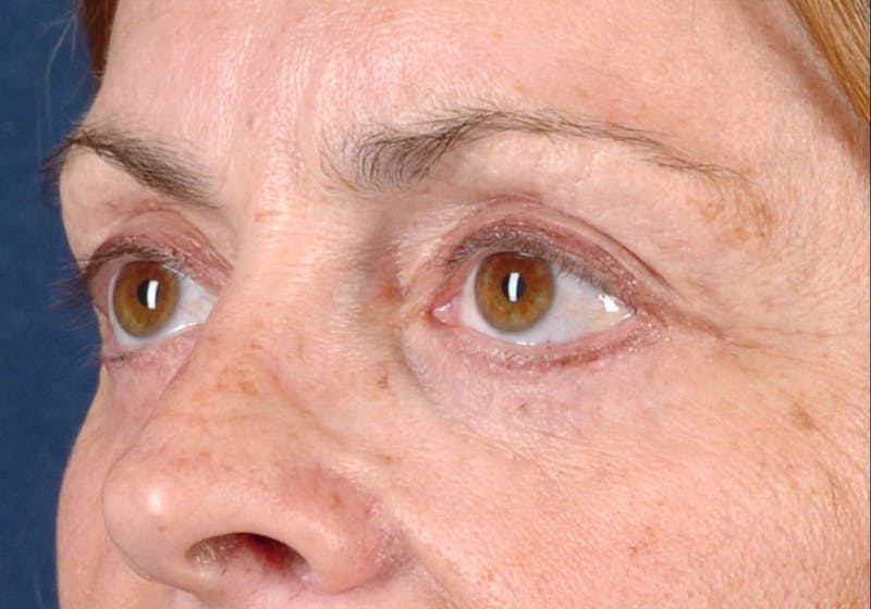 Blepharoplasty Before & After Gallery - Patient 9698228 - Image 4