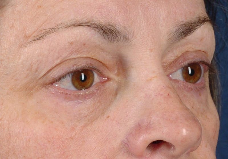 Blepharoplasty Before & After Gallery - Patient 9698228 - Image 5