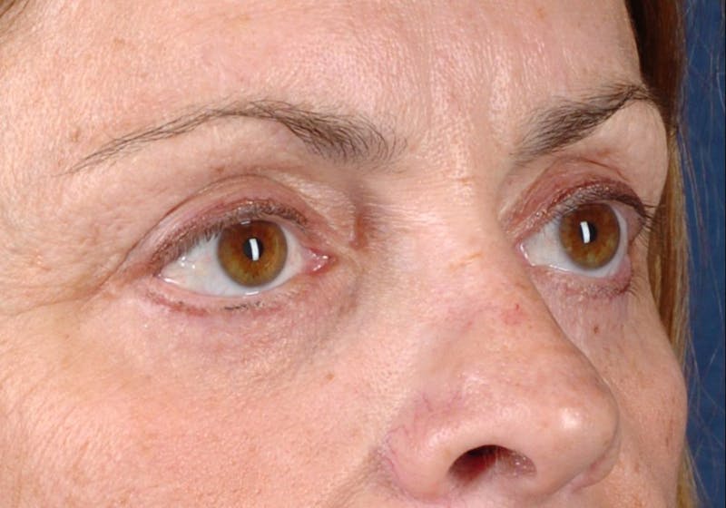 Blepharoplasty Before & After Gallery - Patient 9698228 - Image 6