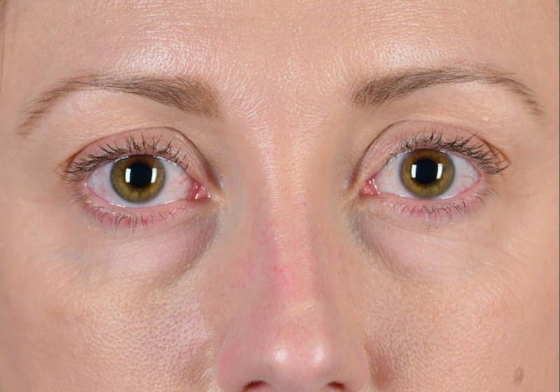 Blepharoplasty Before & After Gallery - Patient 9698234 - Image 1