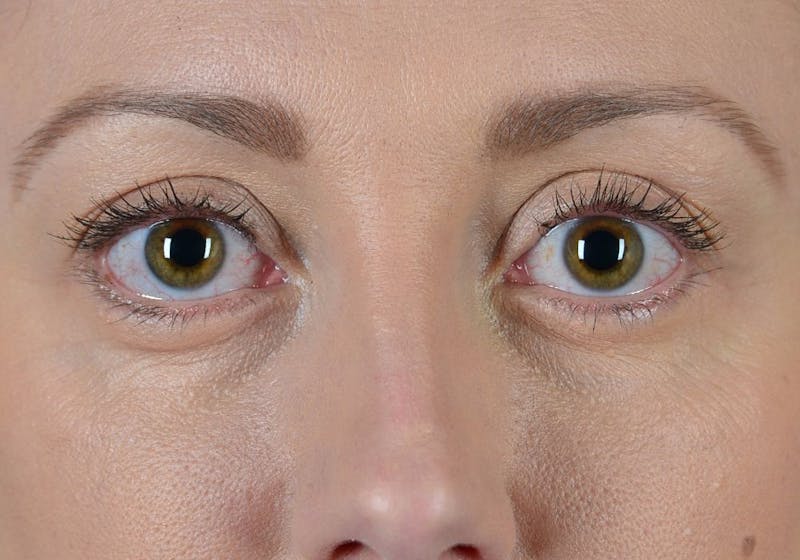 Blepharoplasty Before & After Gallery - Patient 9698234 - Image 2