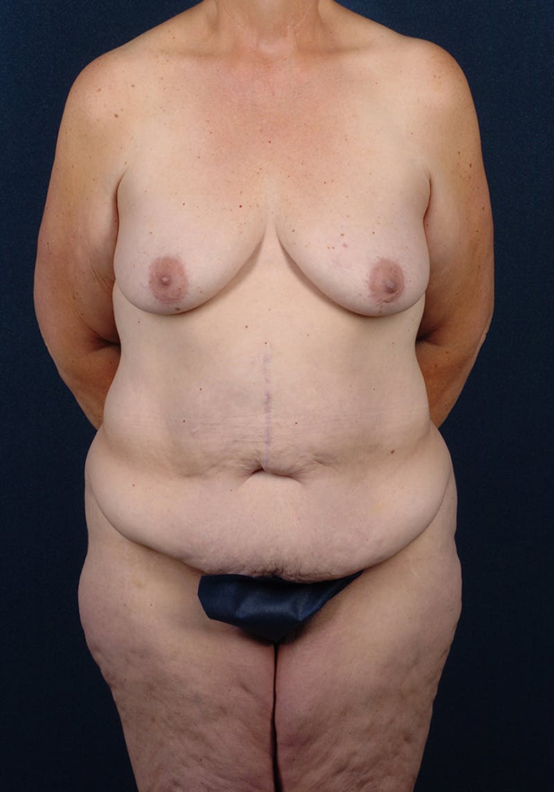 Lower Body Lift Before & After Gallery - Patient 9698242 - Image 1
