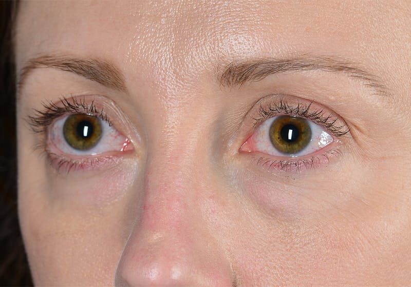 Blepharoplasty Before & After Gallery - Patient 9698234 - Image 3