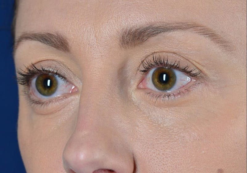 Blepharoplasty Before & After Gallery - Patient 9698234 - Image 4