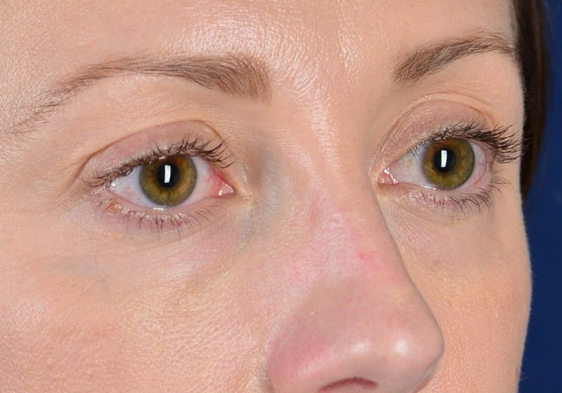 Blepharoplasty Before & After Gallery - Patient 9698234 - Image 5
