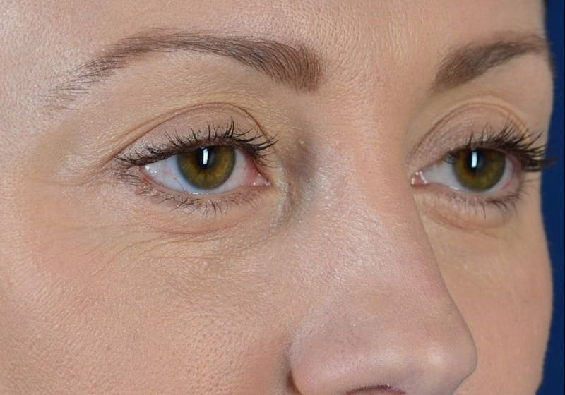 Blepharoplasty Before & After Gallery - Patient 9698234 - Image 6