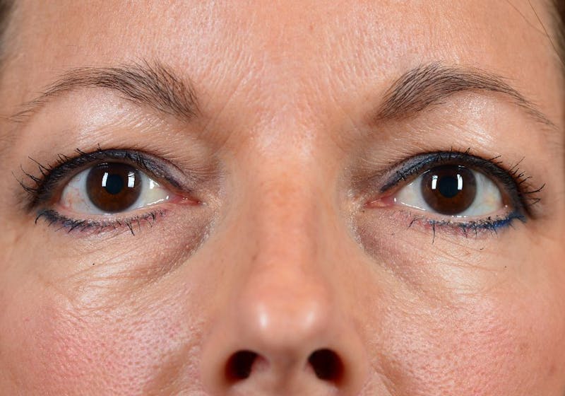 Blepharoplasty Before & After Gallery - Patient 9698241 - Image 1