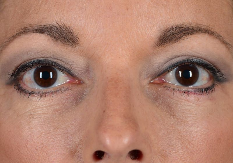 Blepharoplasty Before & After Gallery - Patient 9698241 - Image 2