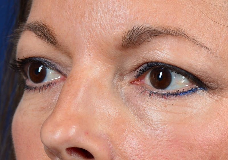 Blepharoplasty Before & After Gallery - Patient 9698241 - Image 3
