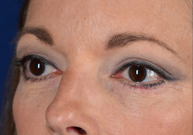 Blepharoplasty Before & After Gallery - Patient 9698241 - Image 4