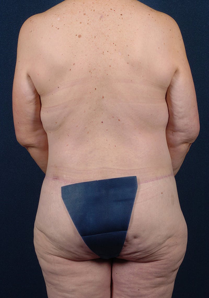 Lower Body Lift Before & After Gallery - Patient 9698242 - Image 7