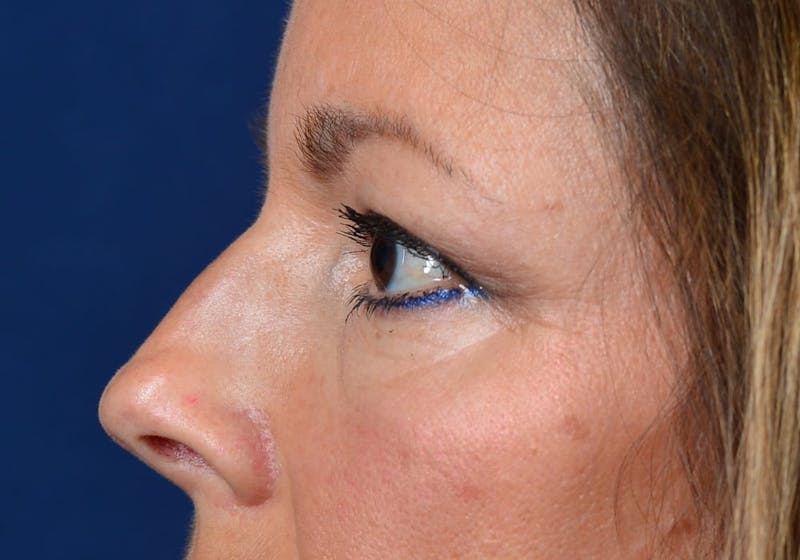 Blepharoplasty Before & After Gallery - Patient 9698241 - Image 5