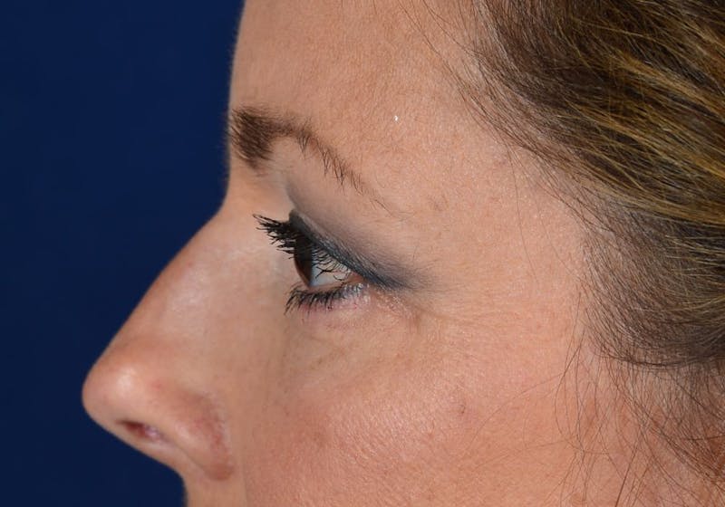 Blepharoplasty Before & After Gallery - Patient 9698241 - Image 6