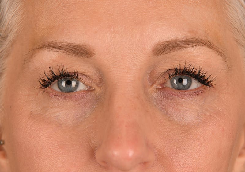 Blepharoplasty Before & After Gallery - Patient 9698246 - Image 1