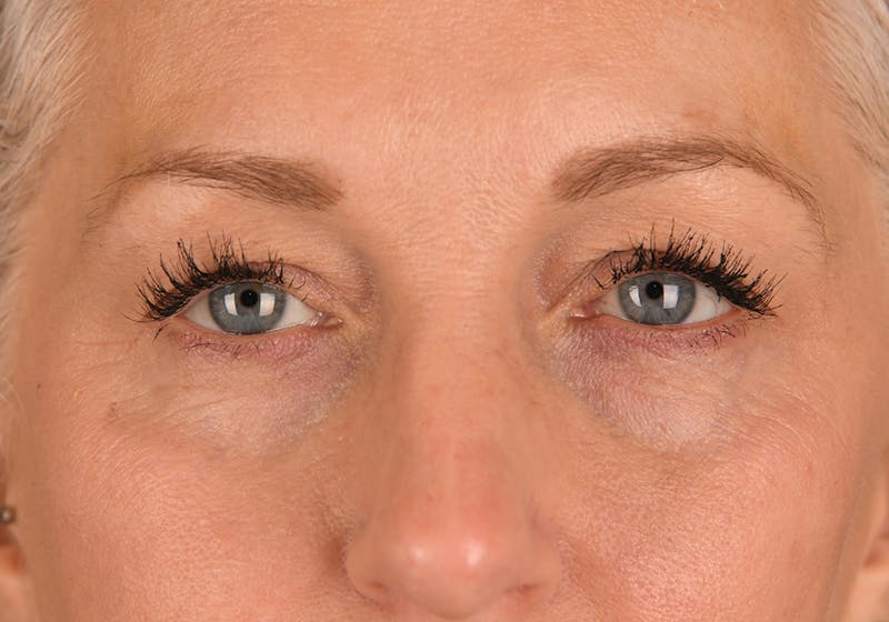 Blepharoplasty Before & After Gallery - Patient 234258 - Image 1