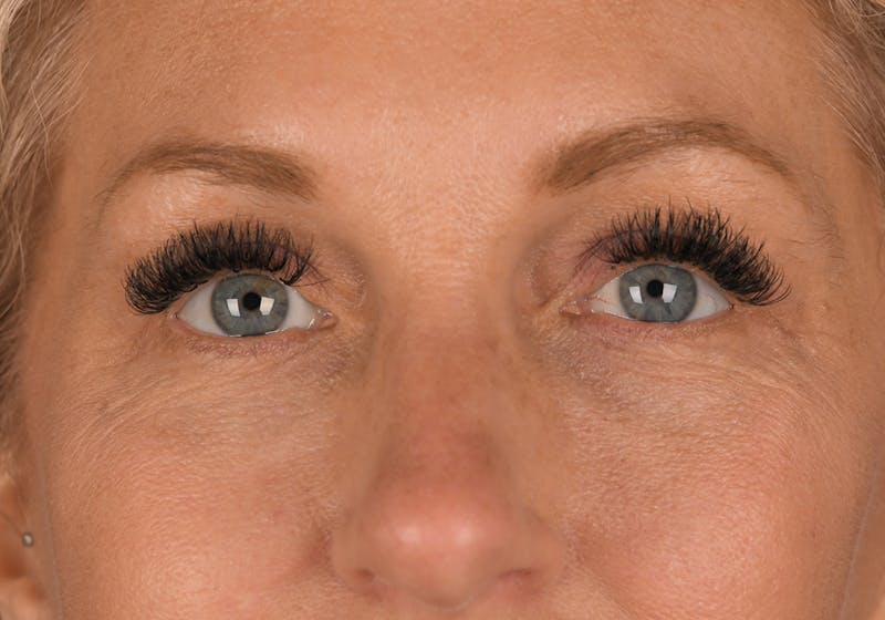 Blepharoplasty Before & After Gallery - Patient 9698246 - Image 2