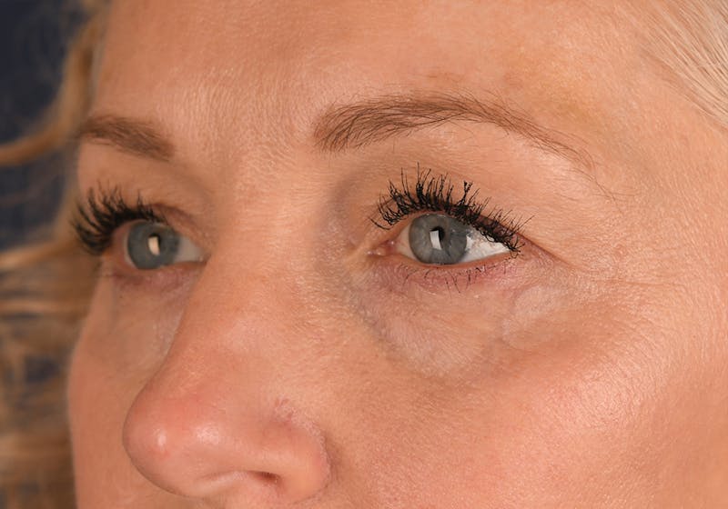 Blepharoplasty Before & After Gallery - Patient 234258 - Image 3