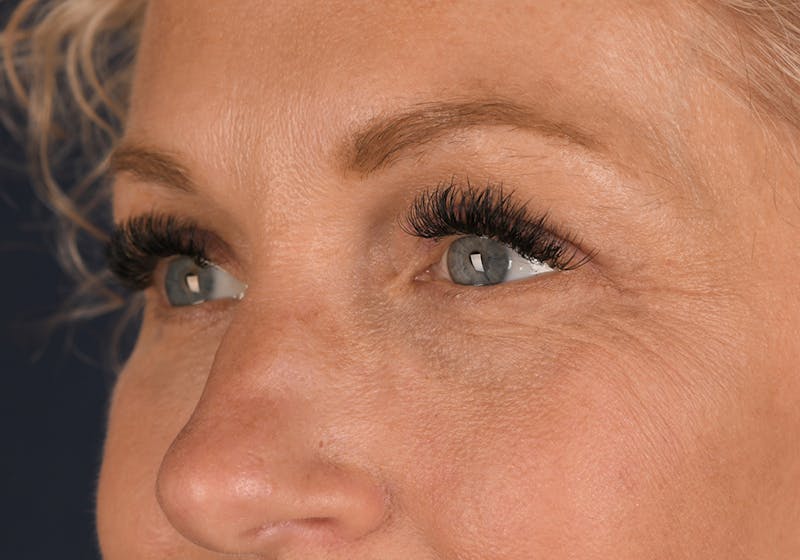 Blepharoplasty Before & After Gallery - Patient 9698246 - Image 4