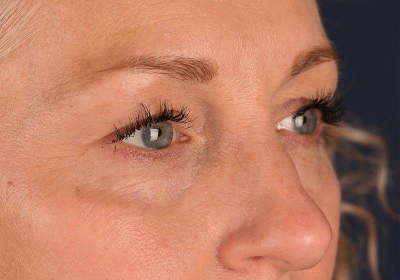 Blepharoplasty Before & After Gallery - Patient 9698246 - Image 5